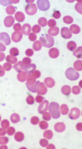 Top 9 Side Effects Of Turmeric & Curcumin Supplements