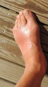 Is Cherry Juice Good For Arthritis? 6 Benefits Of Cherry Juice In Arthritis