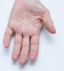 can you diagnose psoriatic arthritis
