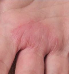 5 Most Common Symptoms Of Psoriatic Arthritis In Hands